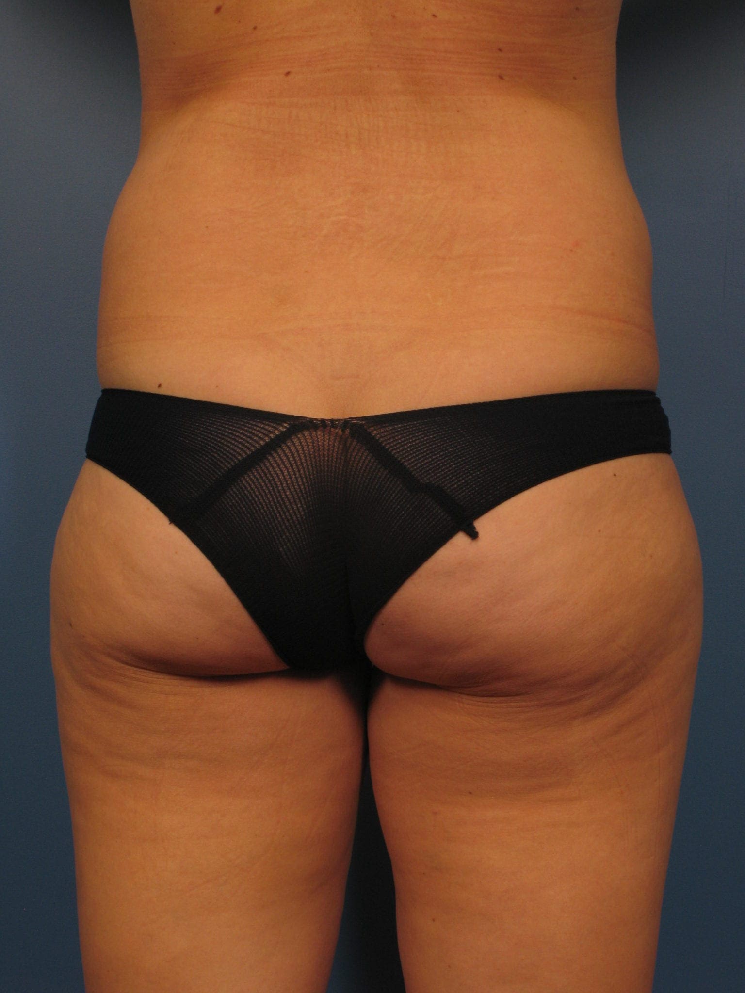 Liposuction - Case 401 - Before