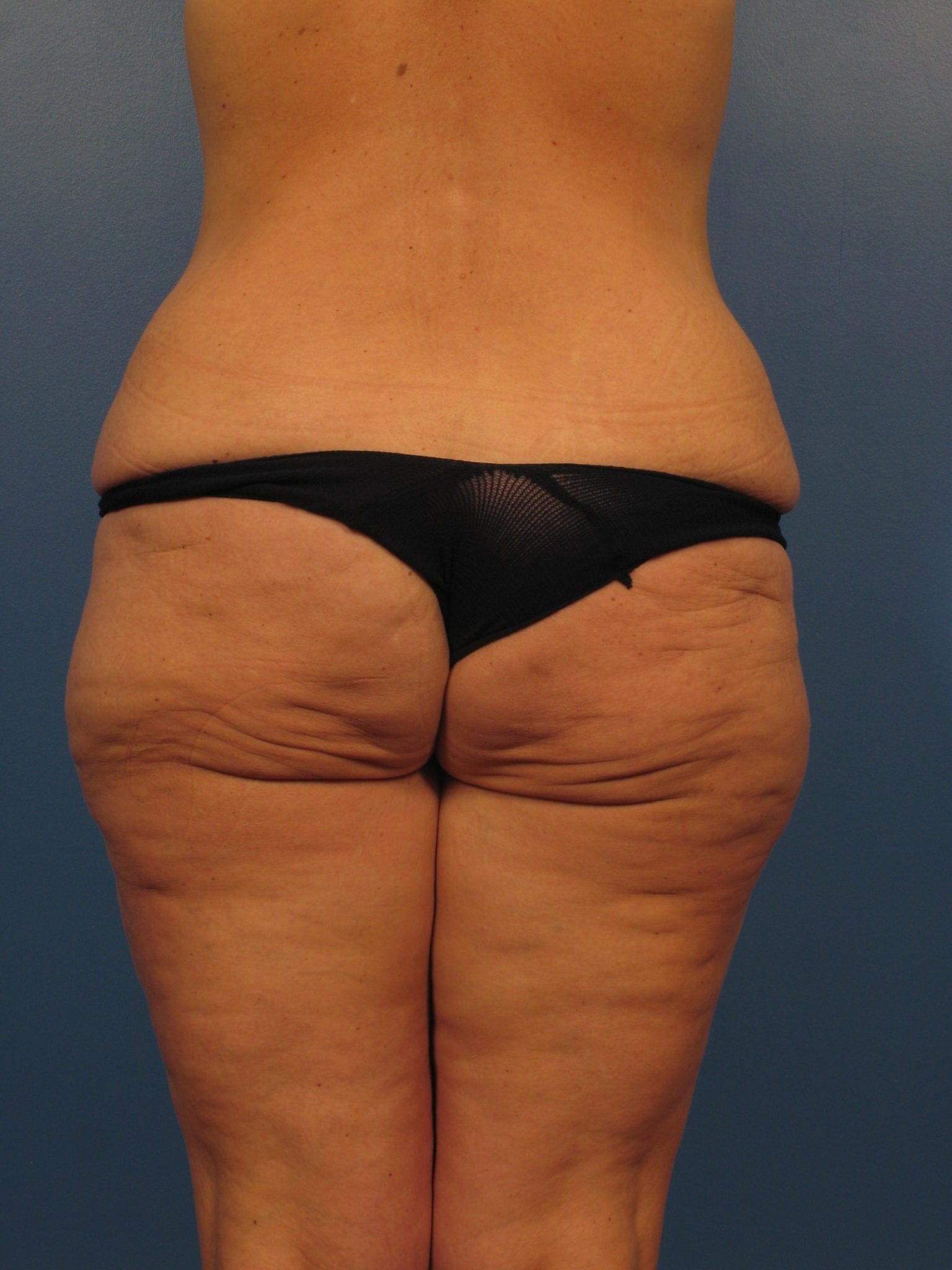After Major Weight Loss Patient Photo - Case 393 - before view-0
