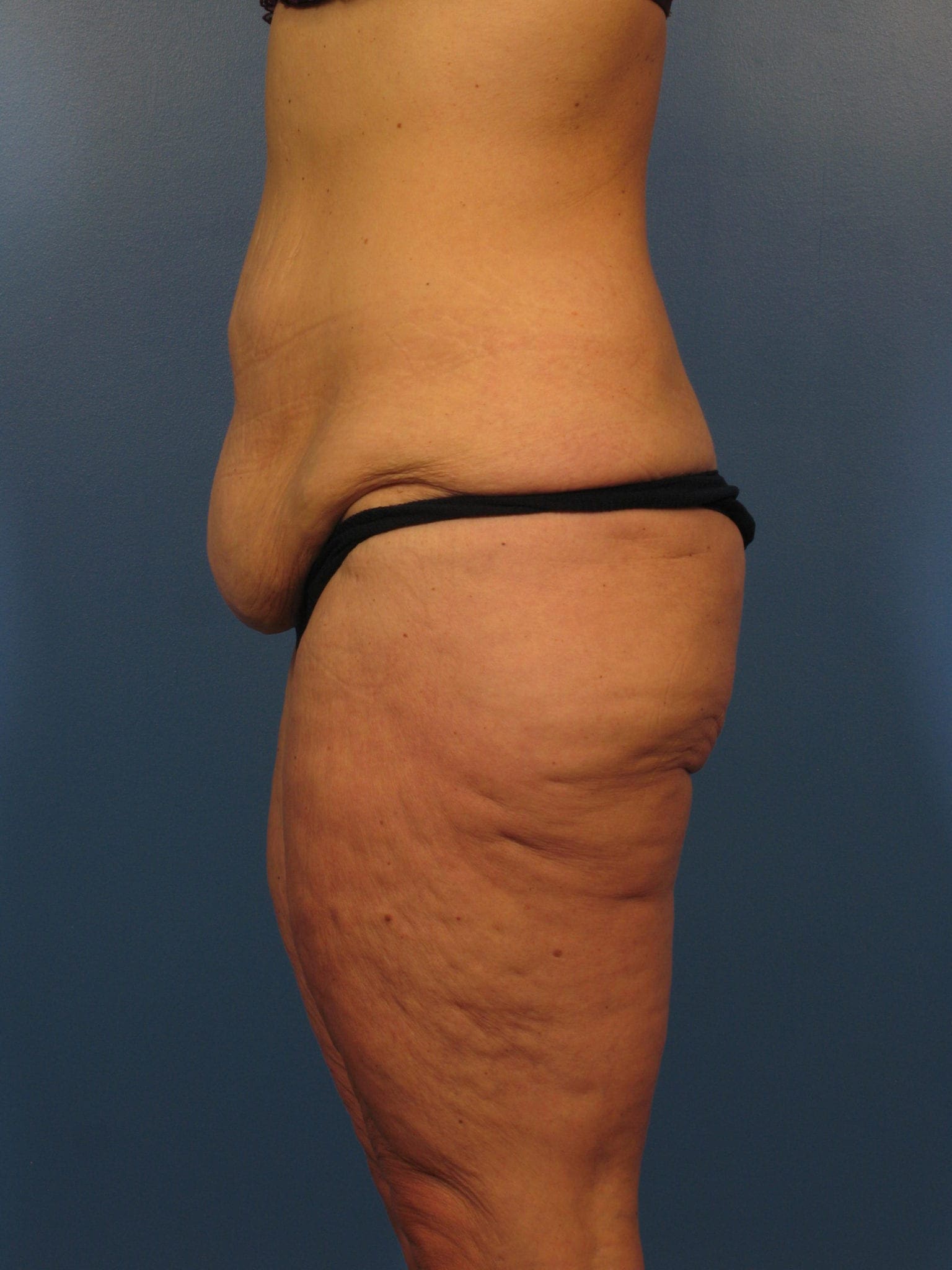 After Major Weight Loss Patient Photo - Case 393 - before view-2