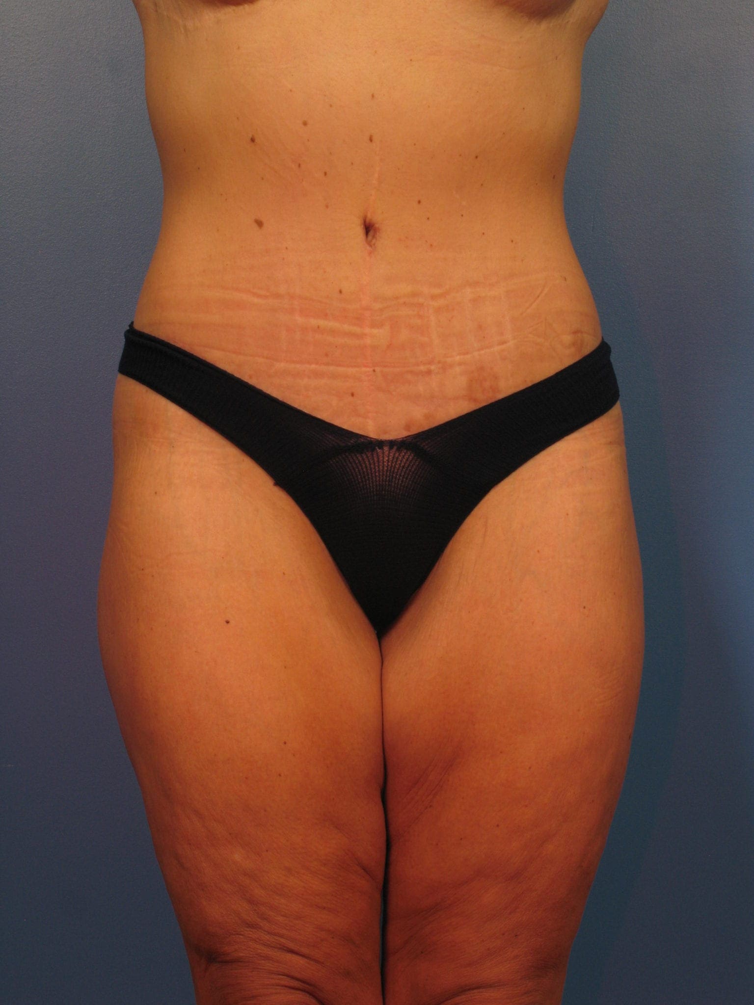 After Major Weight Loss Patient Photo - Case 393 - after view-1