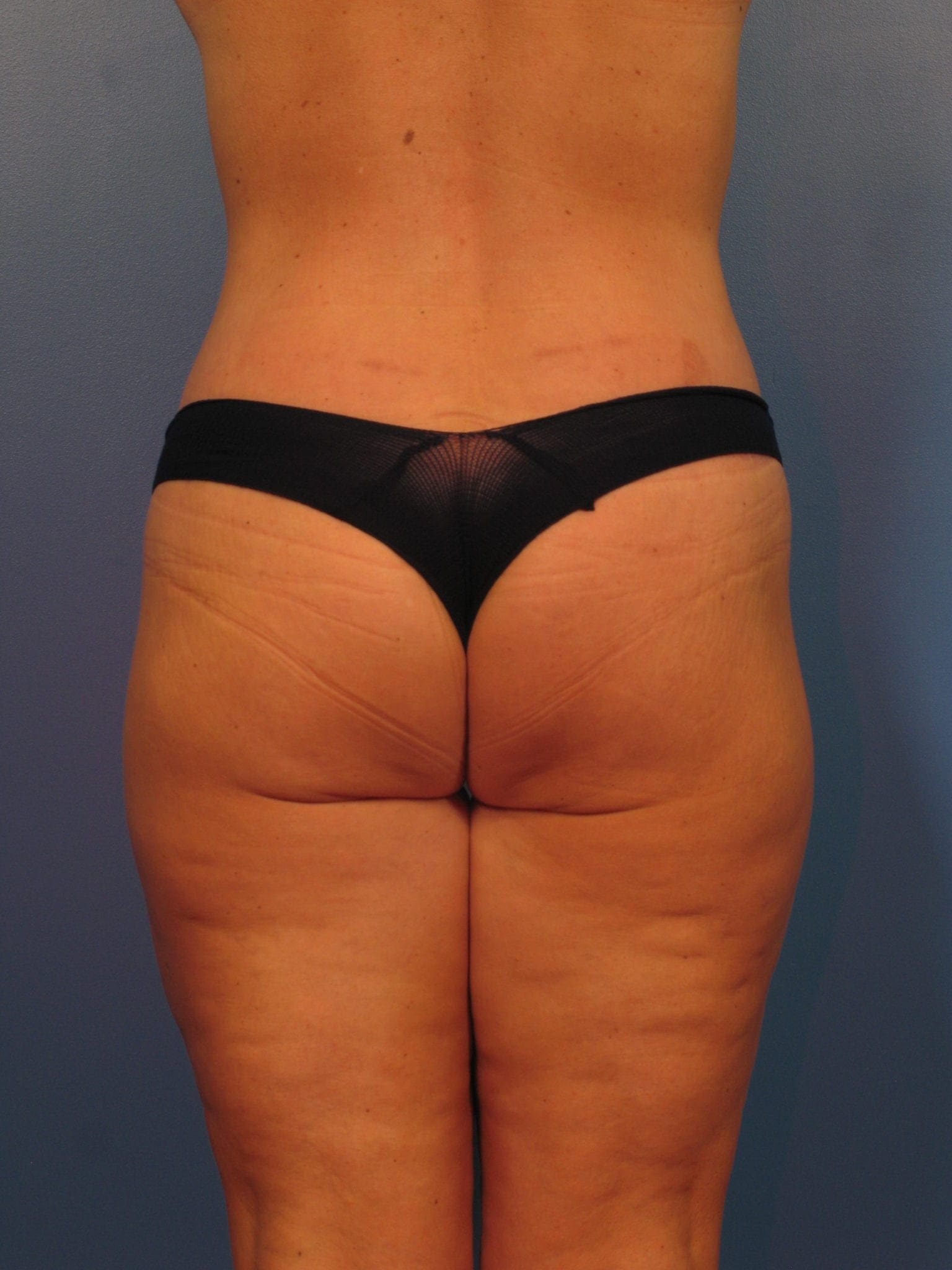 After Major Weight Loss - Case 393 - After