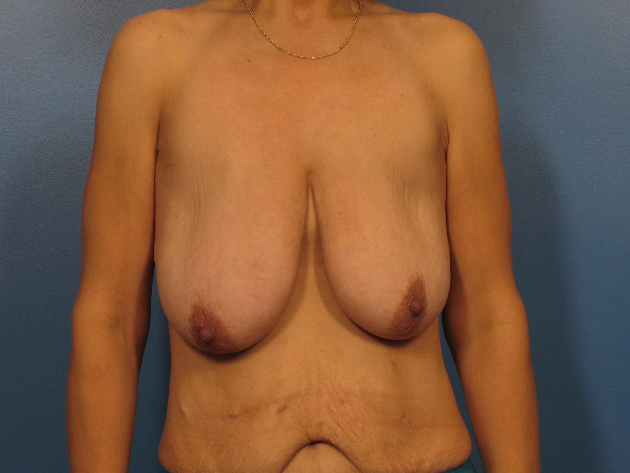 After Major Weight Loss Patient Photo - Case 394 - before view-3