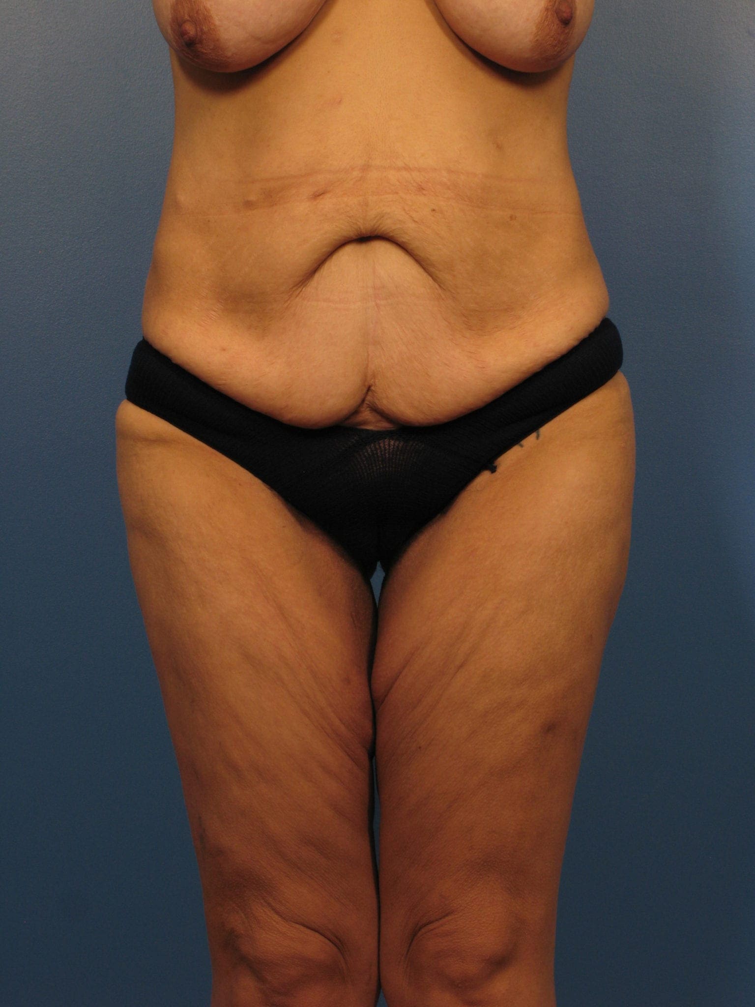 After Major Weight Loss Patient Photo - Case 394 - before view-0
