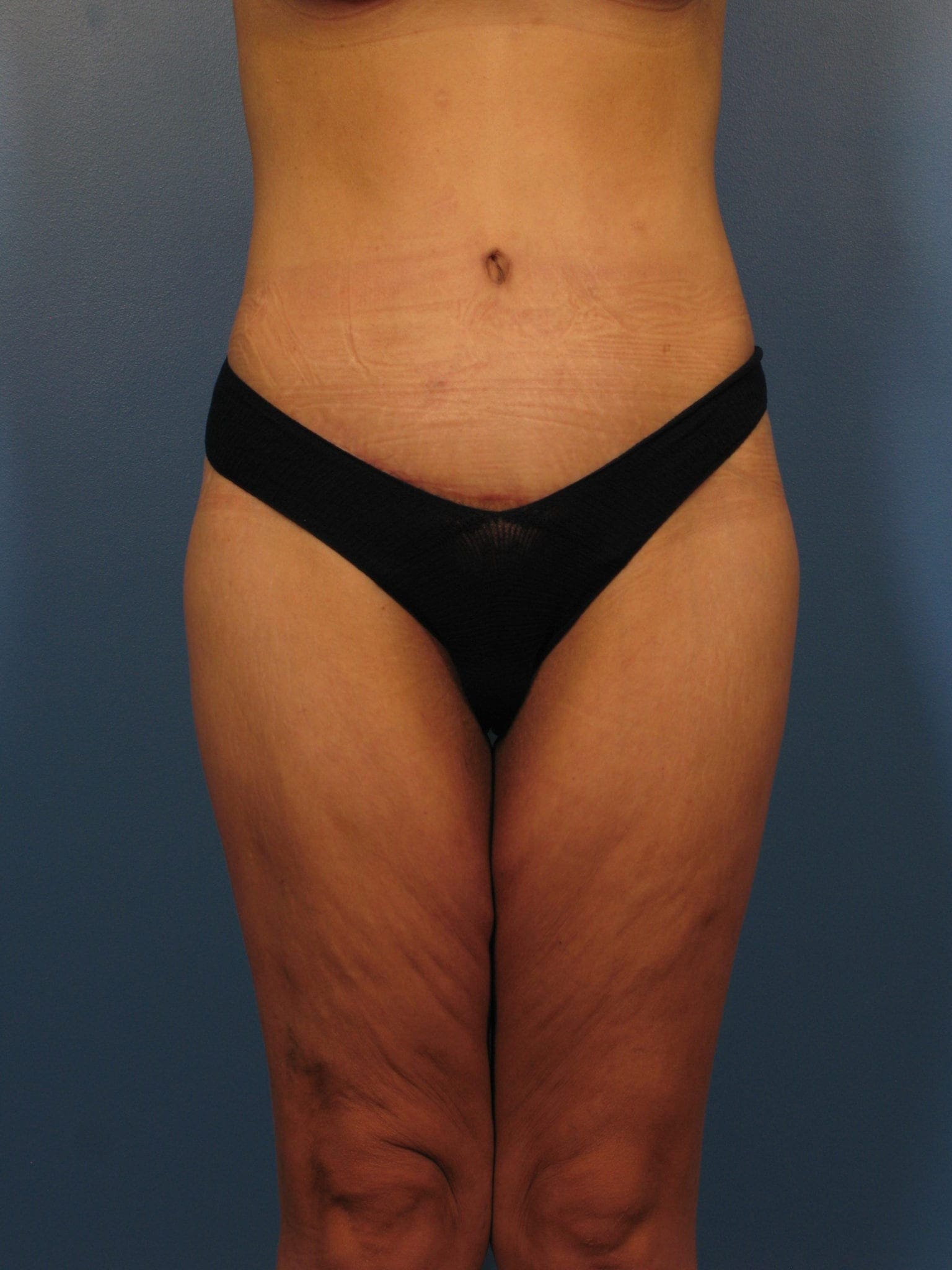 After Major Weight Loss Patient Photo - Case 394 - after view