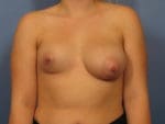 Breast Asymmetry - Case 399 - Before