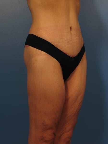 After Major Weight Loss Patient Photo - Case 394 - after view-1