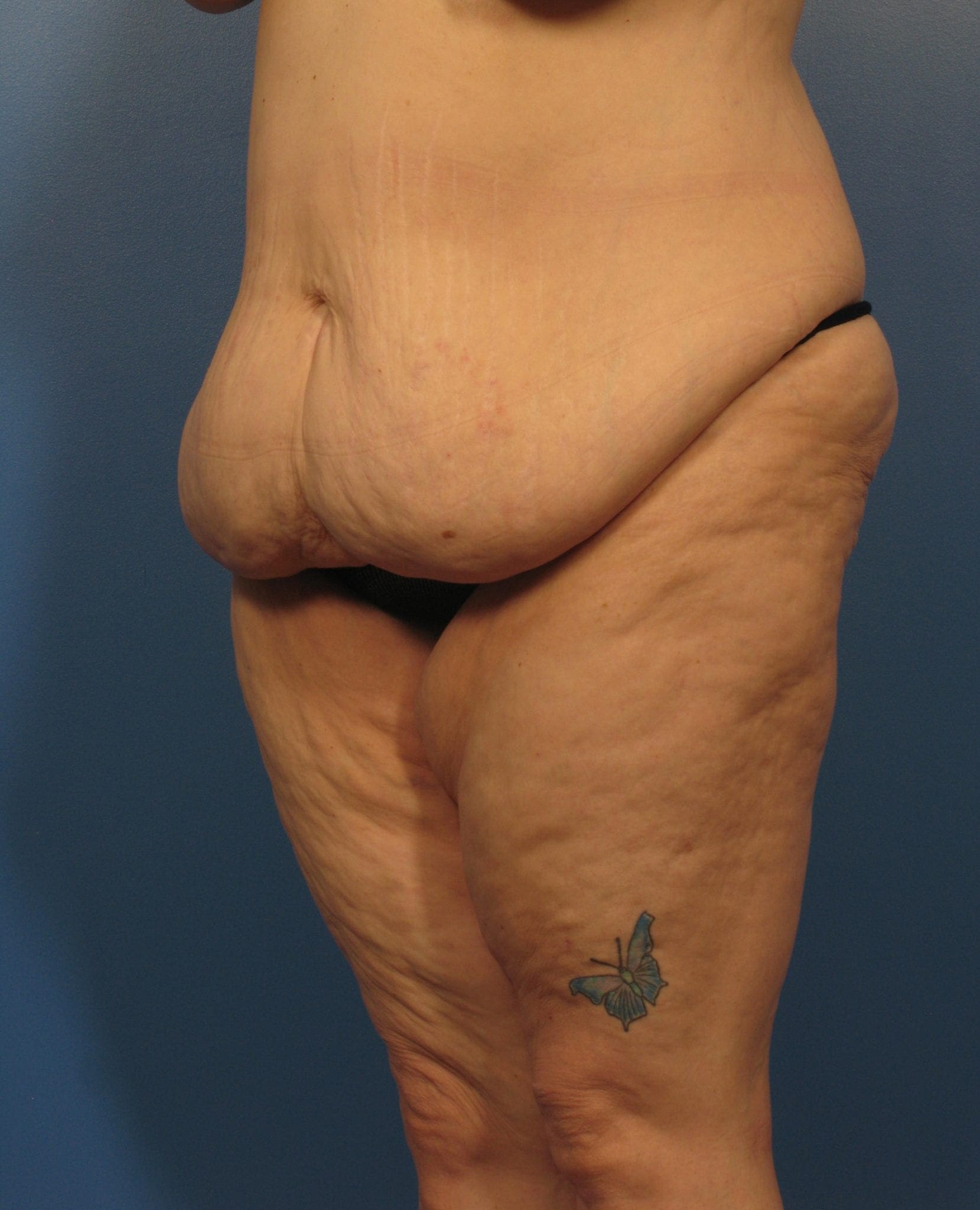 Tummy Tuck Patient Photo - Case 405a - before view-0