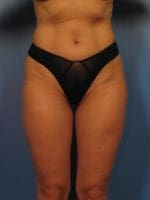 Liposuction - Case 406 - After