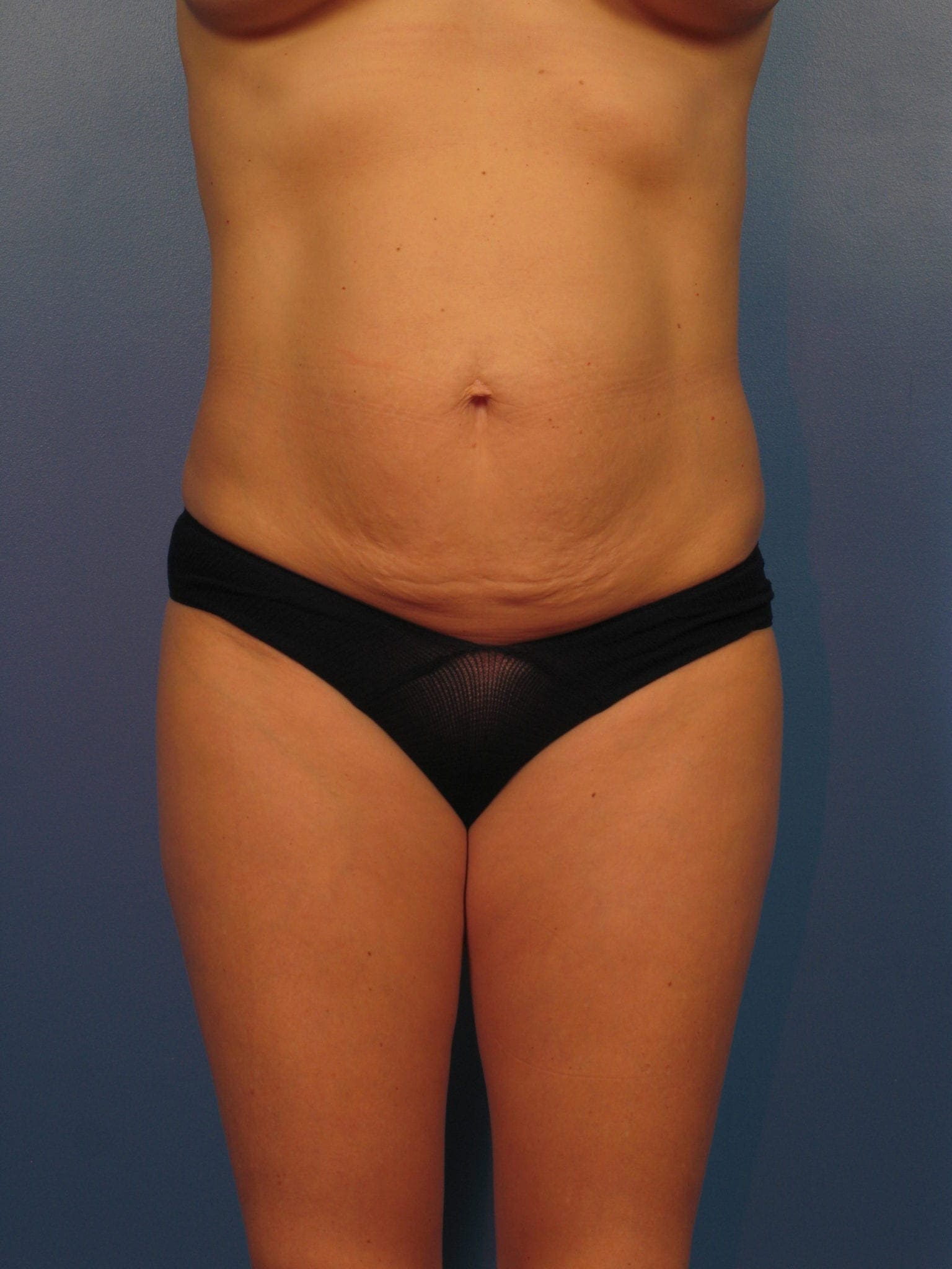 Breast Augmentation with Lift Patient Photo - Case 410a - before view-3