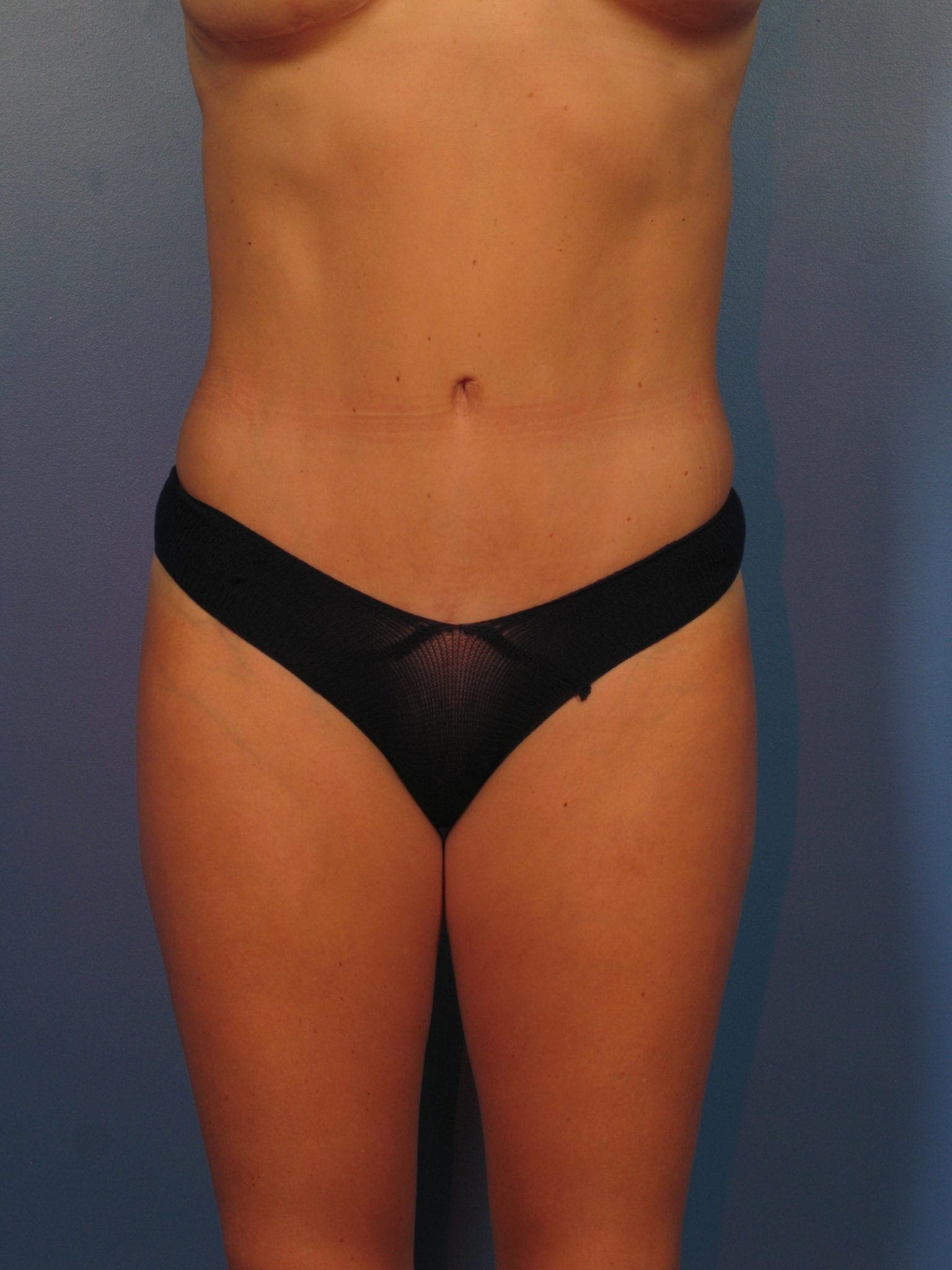 Breast Augmentation with Lift Patient Photo - Case 410a - after view-3