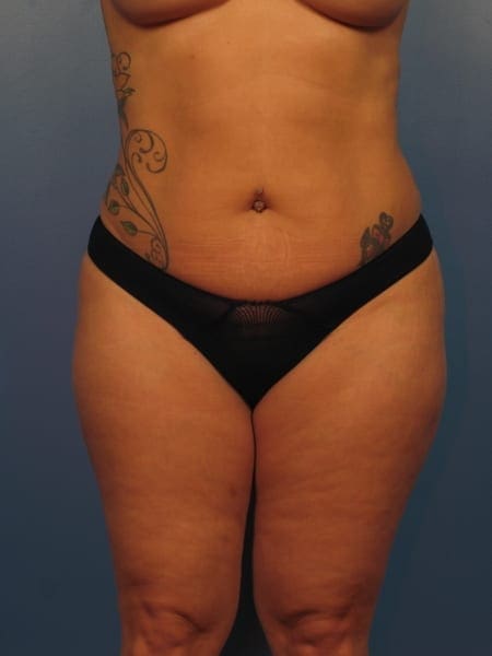 Liposuction Patient Photo - Case 413 - before view-1