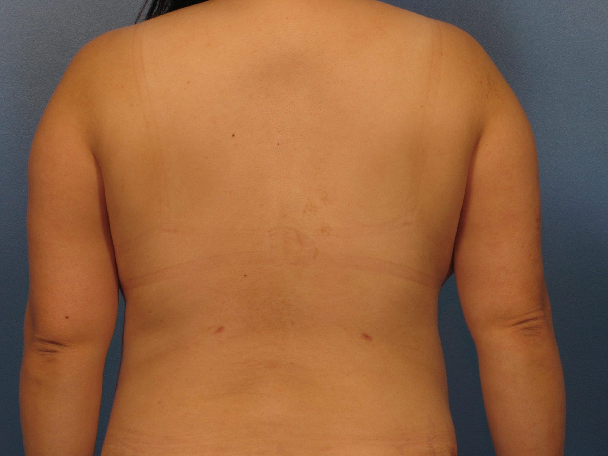 Liposuction - Case 418 - After