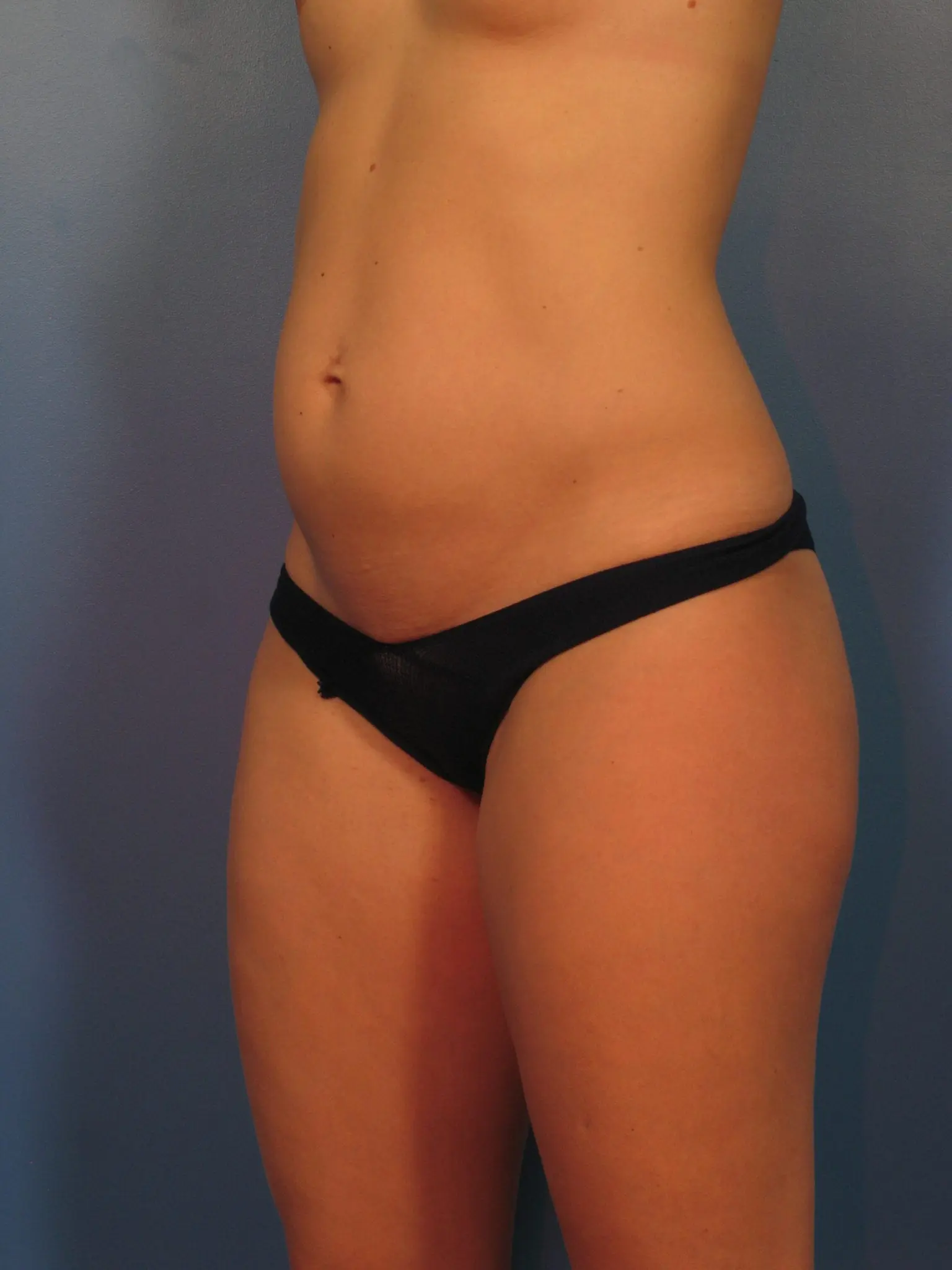 Liposuction - Case 422a - Before