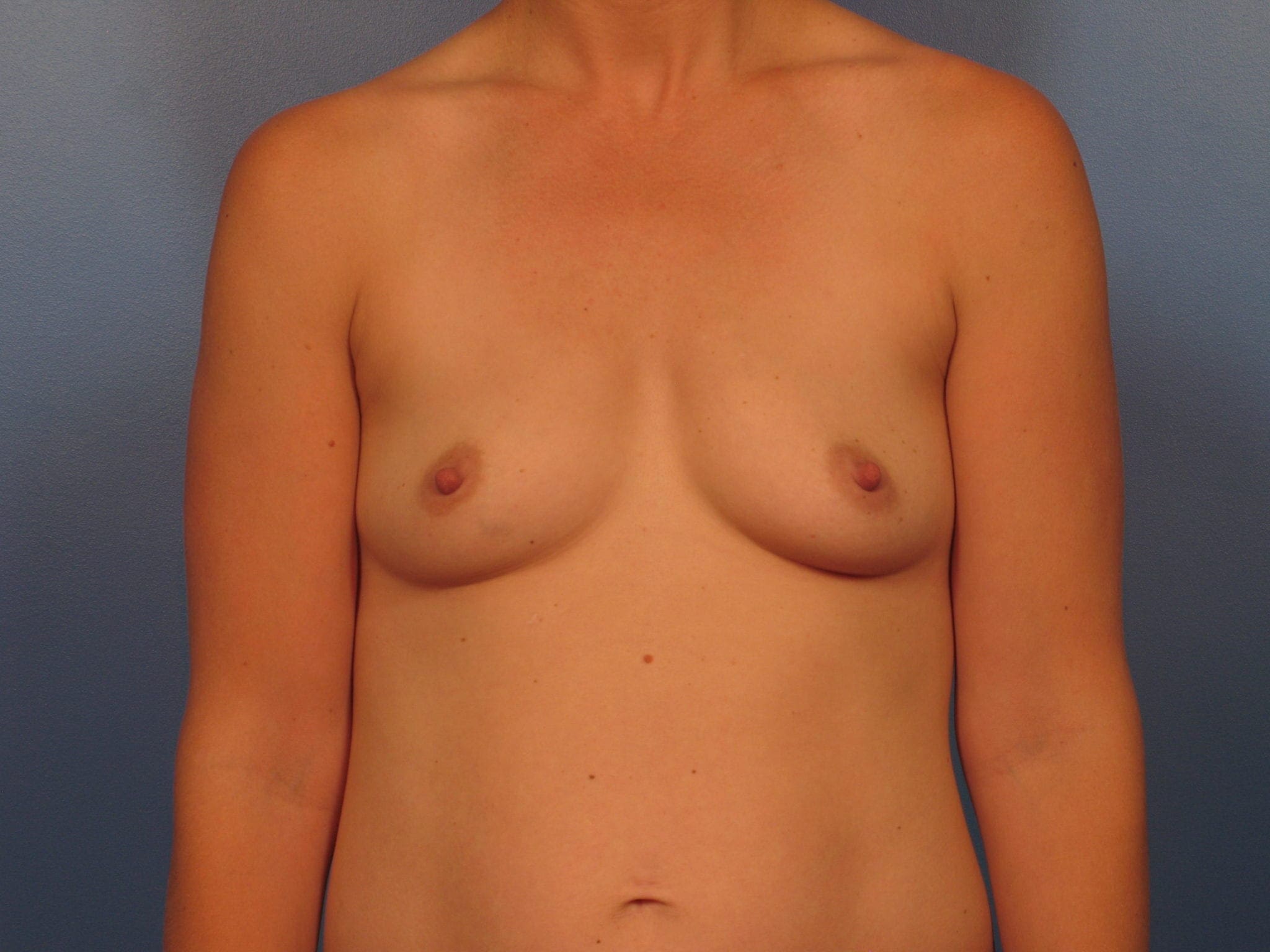 Breast Augmentation - Case 422b - Before