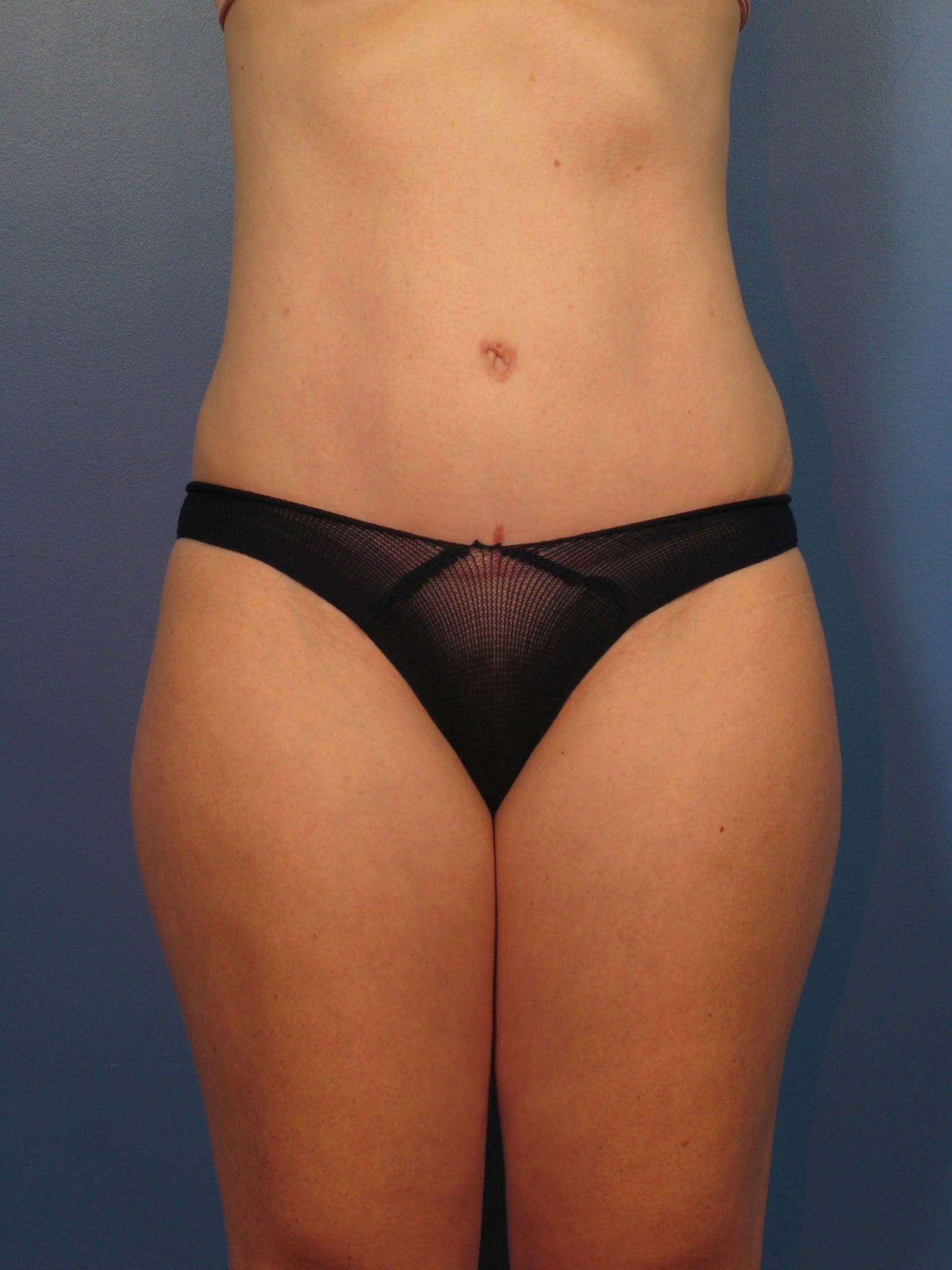 Tummy Tuck Patient Photo - Case 14339 - after view-2