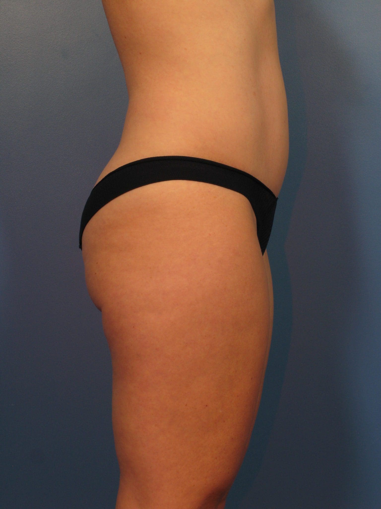 Tummy Tuck Patient Photo - Case 14339 - after view-1