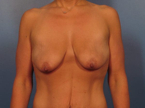 Breast Augmentation Patient Photo - Case 14367 - before view-2