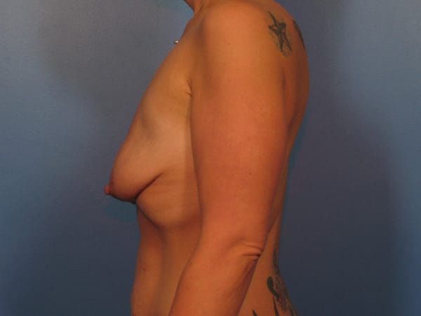 Breast Augmentation Patient Photo - Case 14367 - before view-3