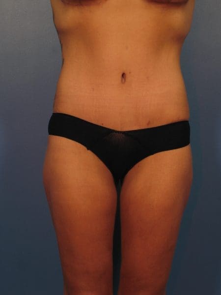 Breast Augmentation - Case 14367 - After