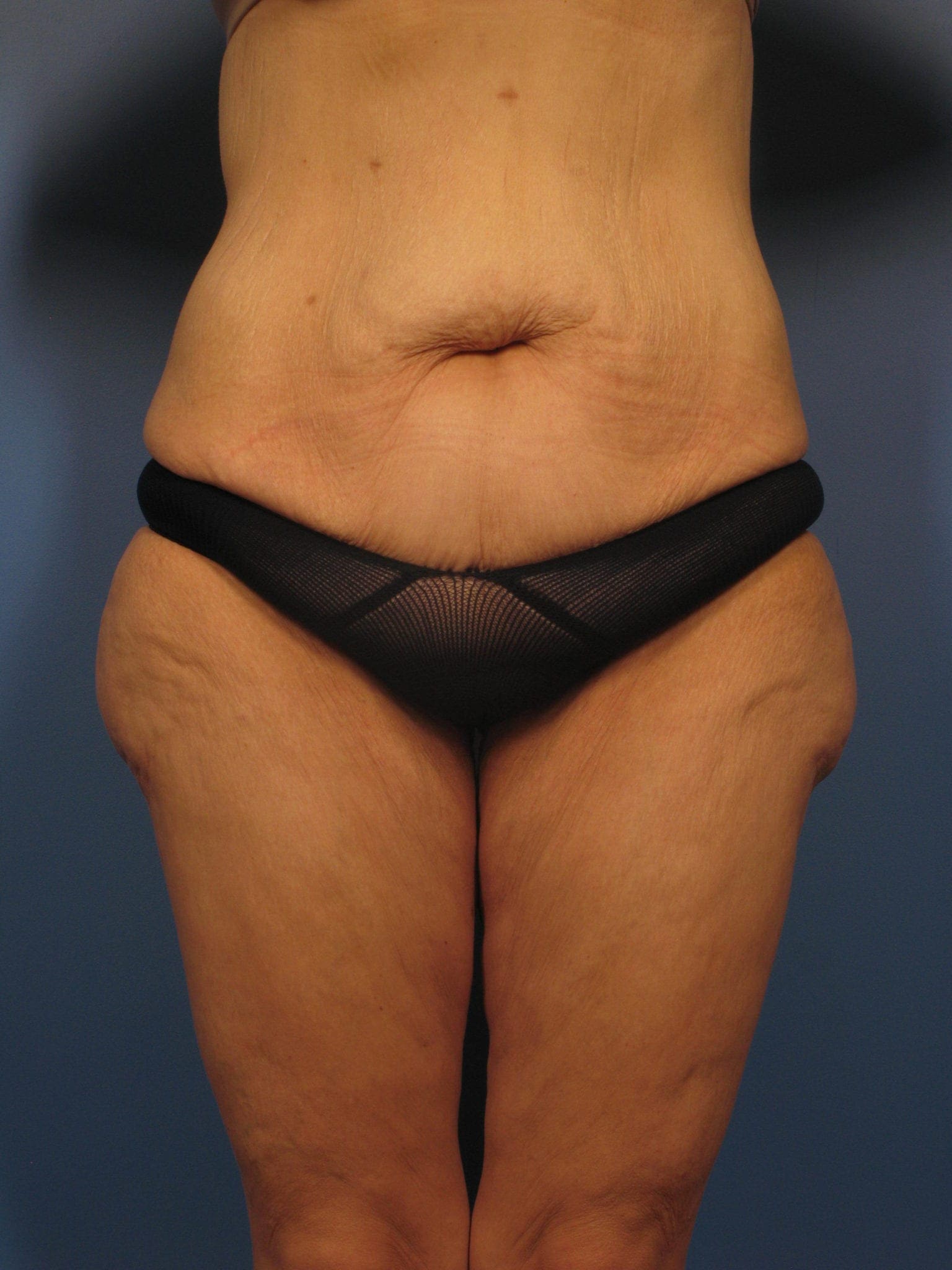 After Major Weight Loss Patient Photo - Case 350 - before view-