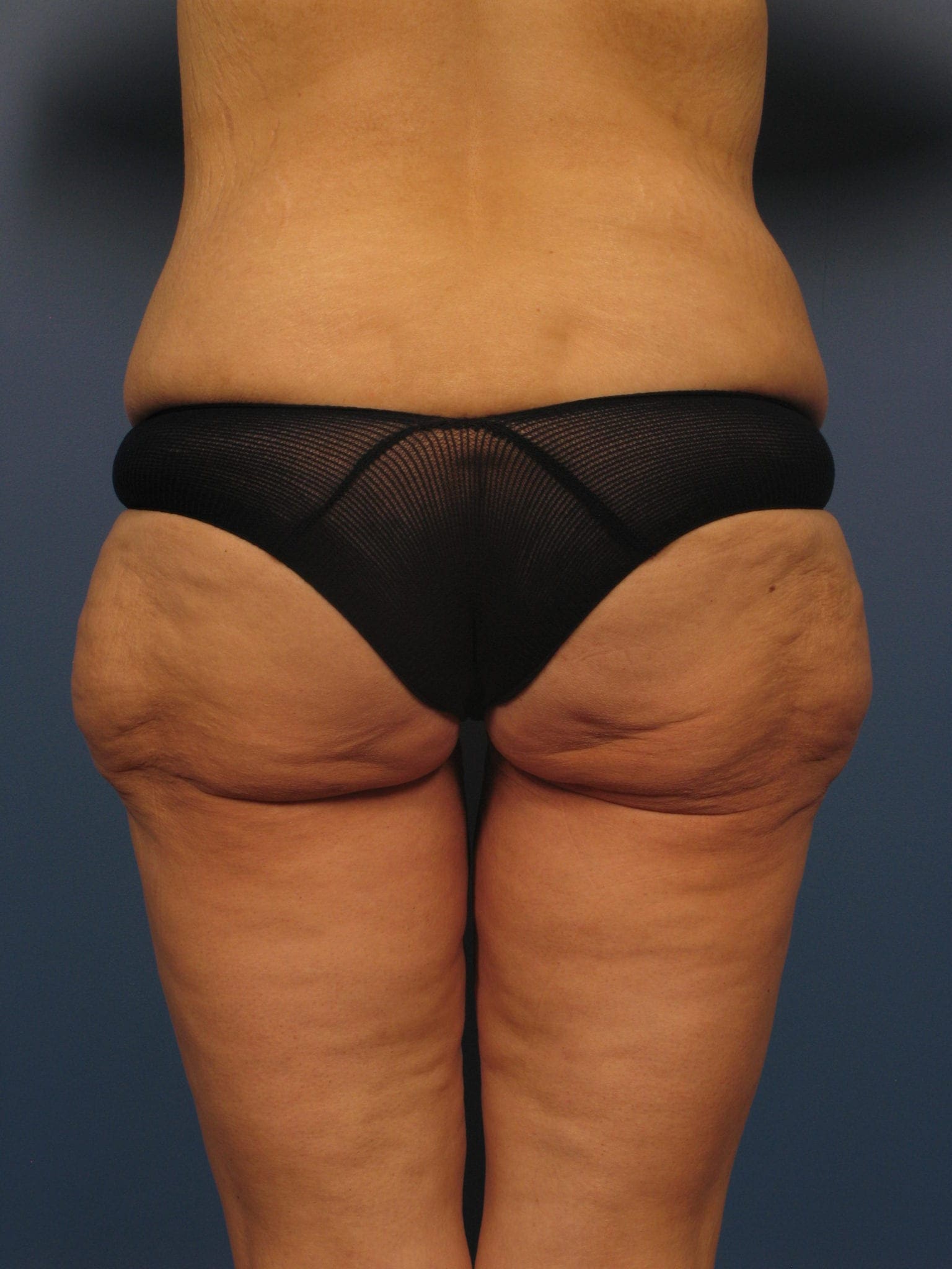 After Major Weight Loss Patient Photo - Case 350 - before view-2