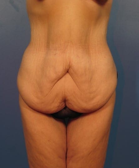 After Major Weight Loss Patient Photo - Case 415 - before view-0