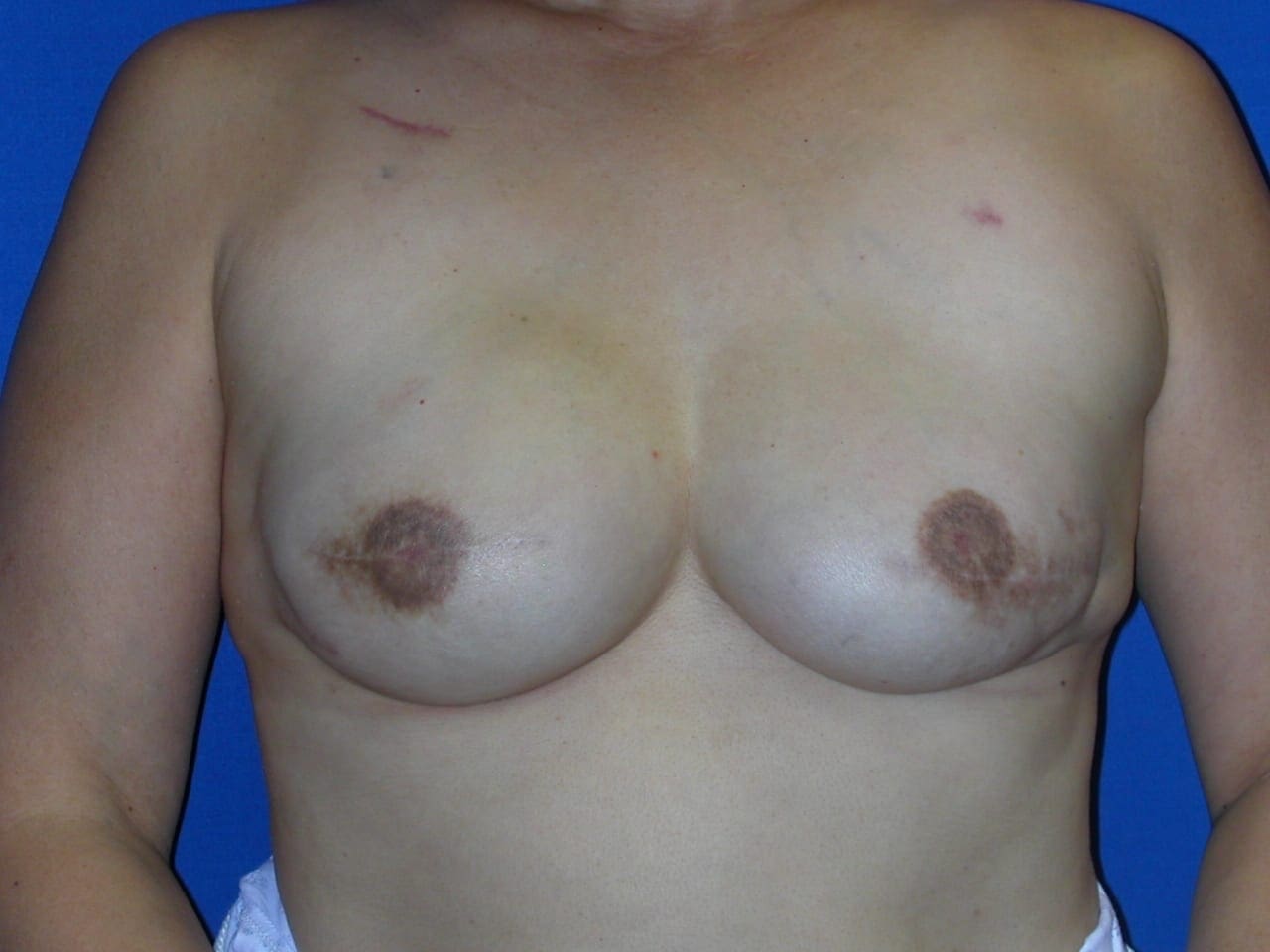 Breast Reconstruction Patient Photo - Case 73 - after view-1
