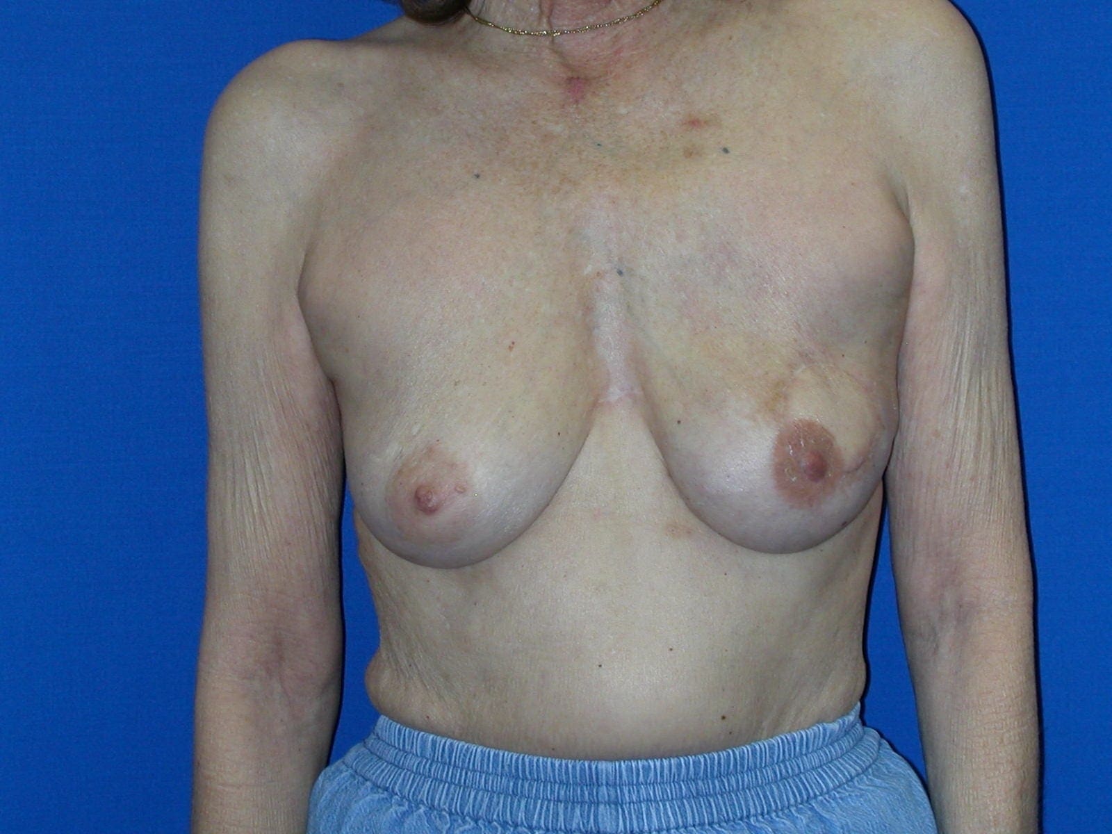 Breast Reconstruction Patient Photo - Case 79 - after view-0