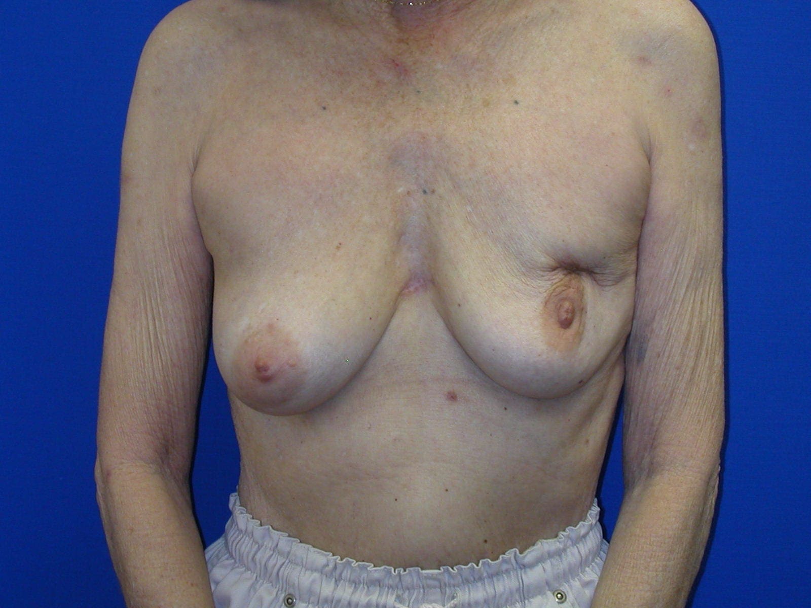 Breast Reconstruction Patient Photo - Case 79 - before view-