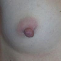Nipple Reduction - Case 14 - Before
