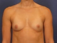 Breast Augmentation - Case 147 - Before