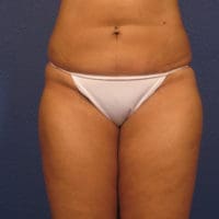 Liposuction - Case 156 - After