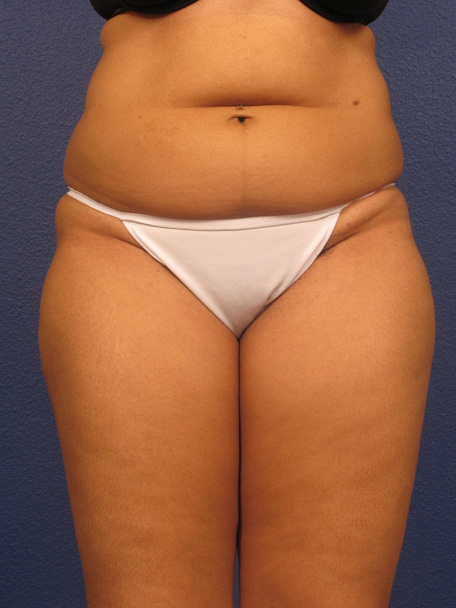 Liposuction - Case 156 - Before
