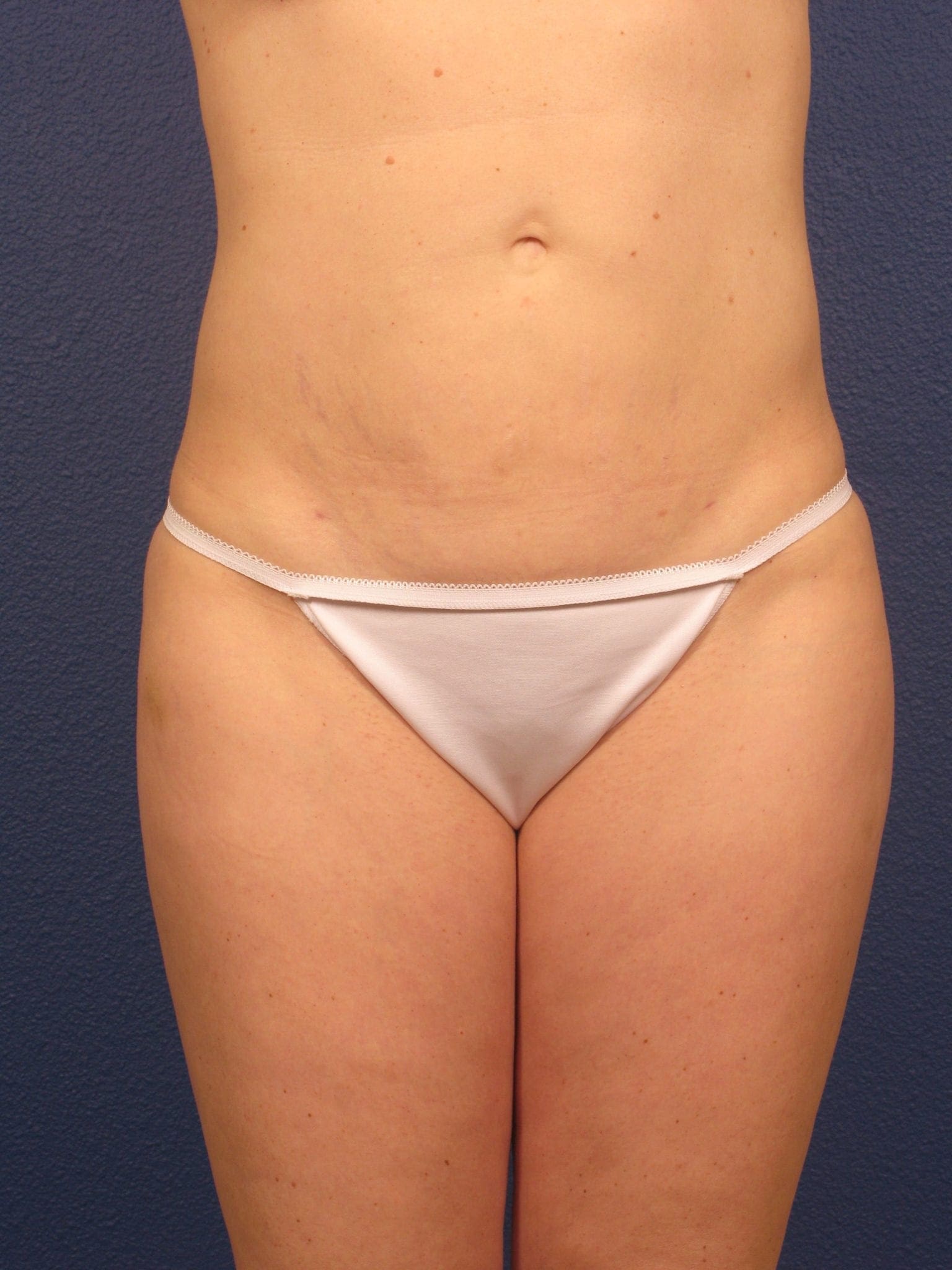 Liposuction Patient Photo - Case 166 - after view