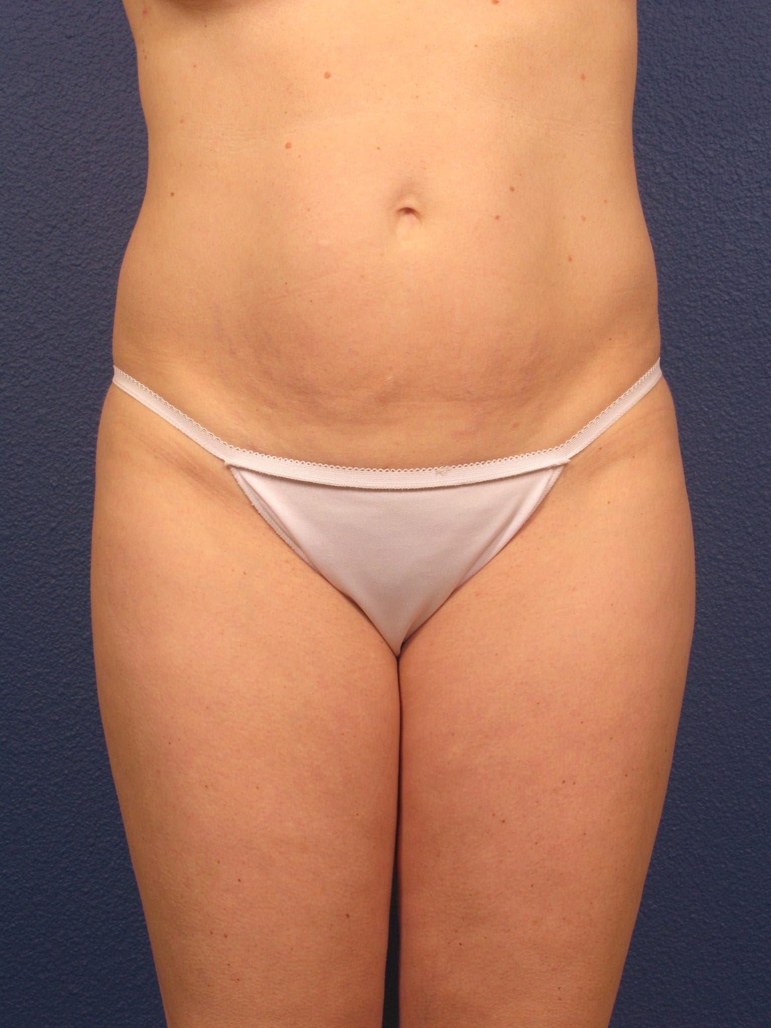 Liposuction - Case 166 - Before