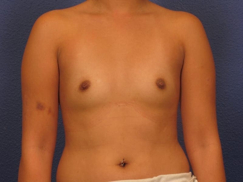 Breast Augmentation Patient Photo - Case 225 - before view-