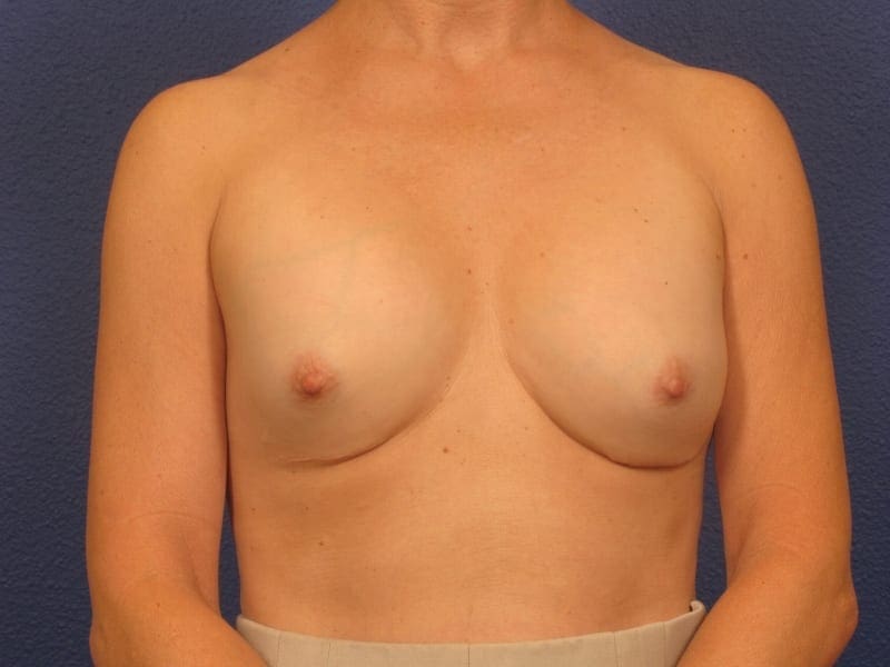 Breast Revision Patient Photo - Case 269 - before view-2