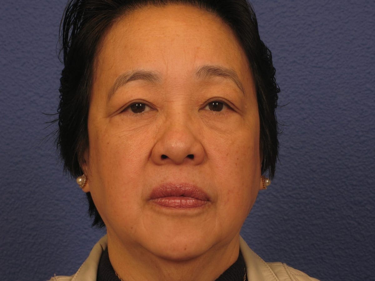 Lower Eyelid Lift Patient Photo - Case 280 - after view-2