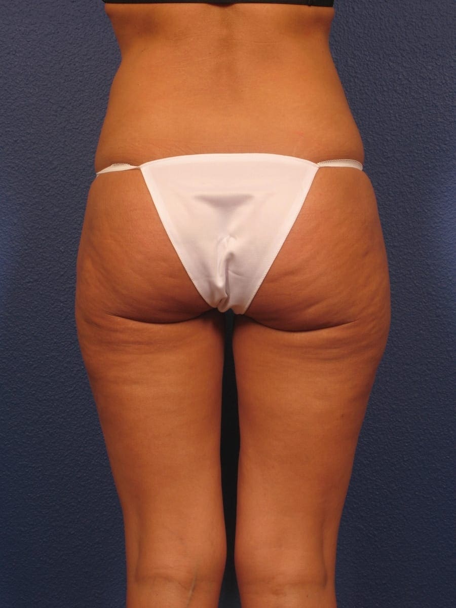 Liposuction - Case 312 - After