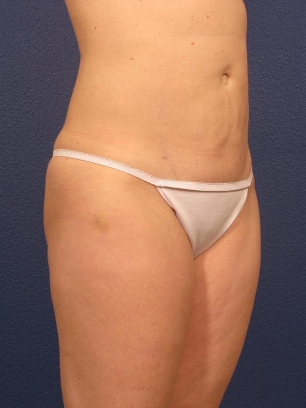 Liposuction Patient Photo - Case 166 - after view-1