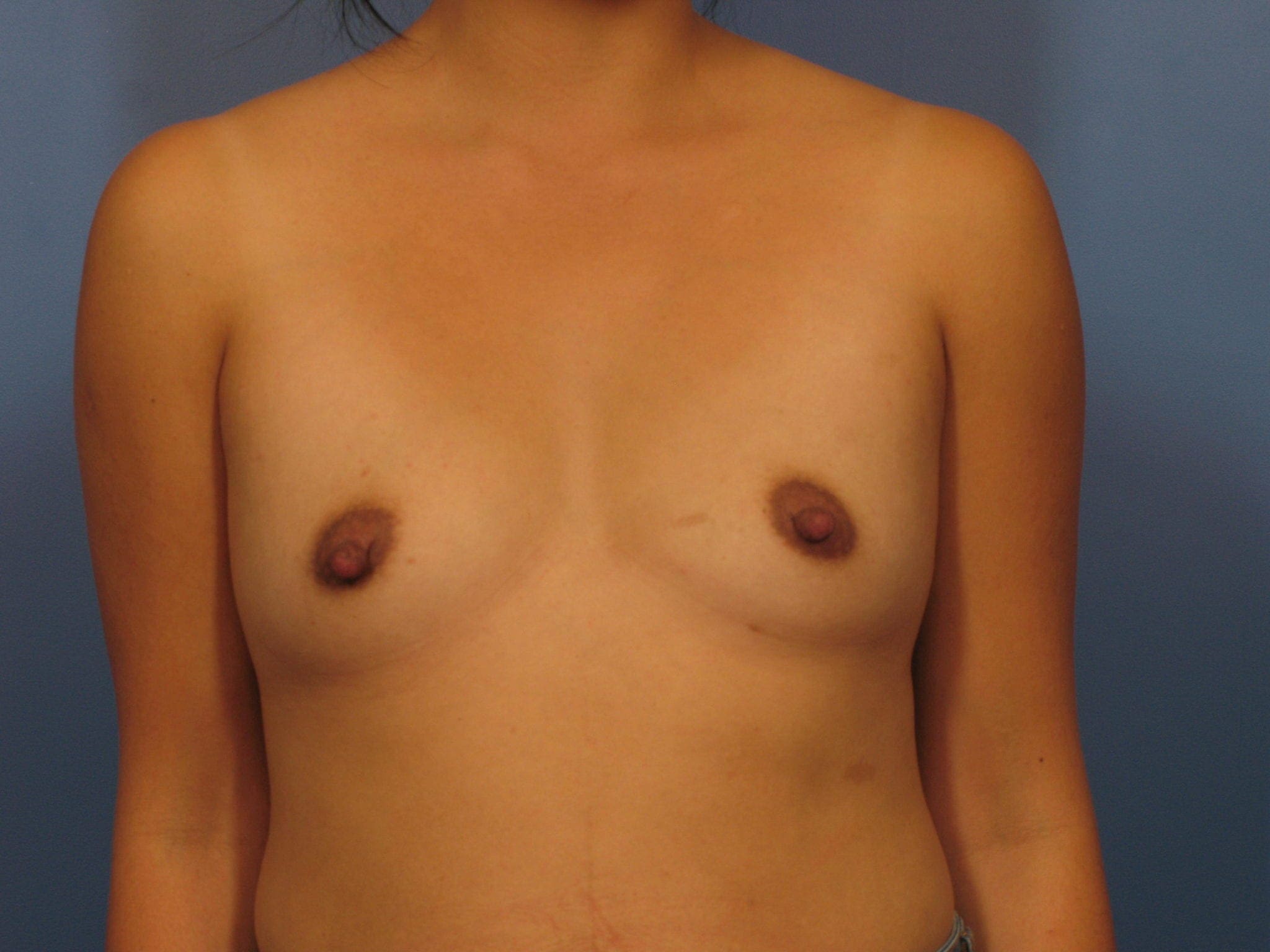 Breast Augmentation Patient Photo - Case 332 - before view-0