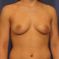 Breast Augmentation - Case 336 - Before