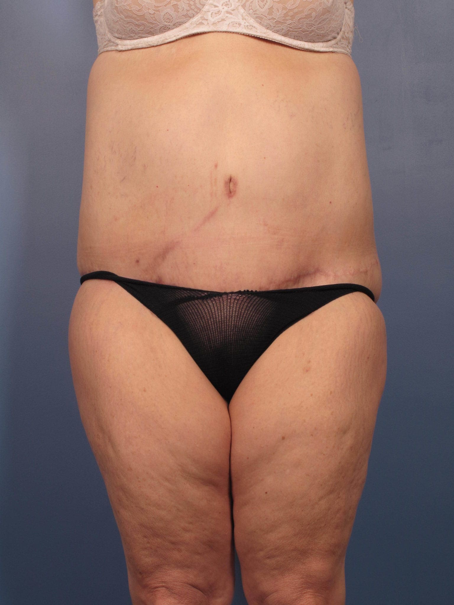 After Major Weight Loss Patient Photo - Case 352 - after view-0
