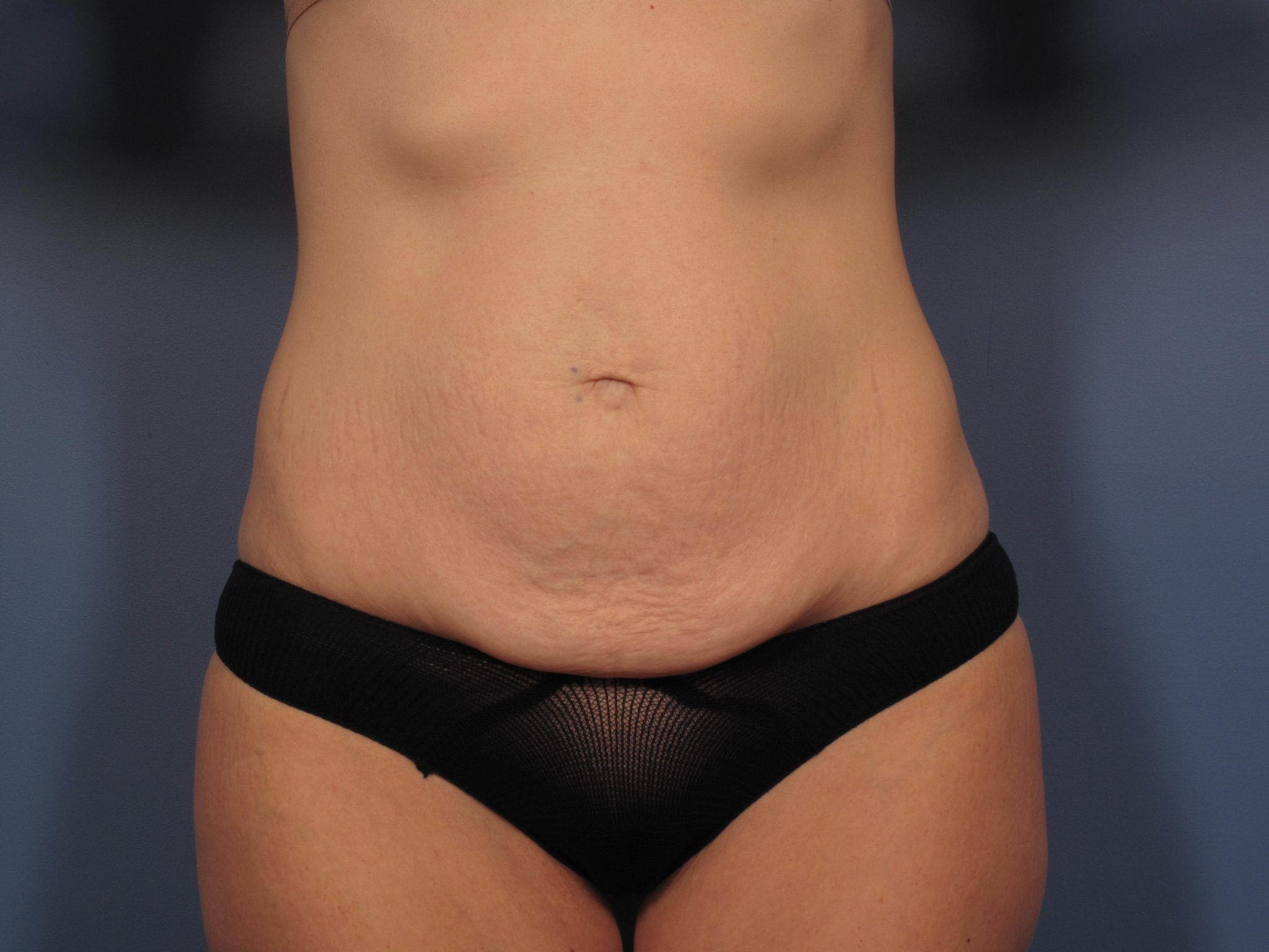 Tummy Tuck Patient Photo - Case 353 - before view-0