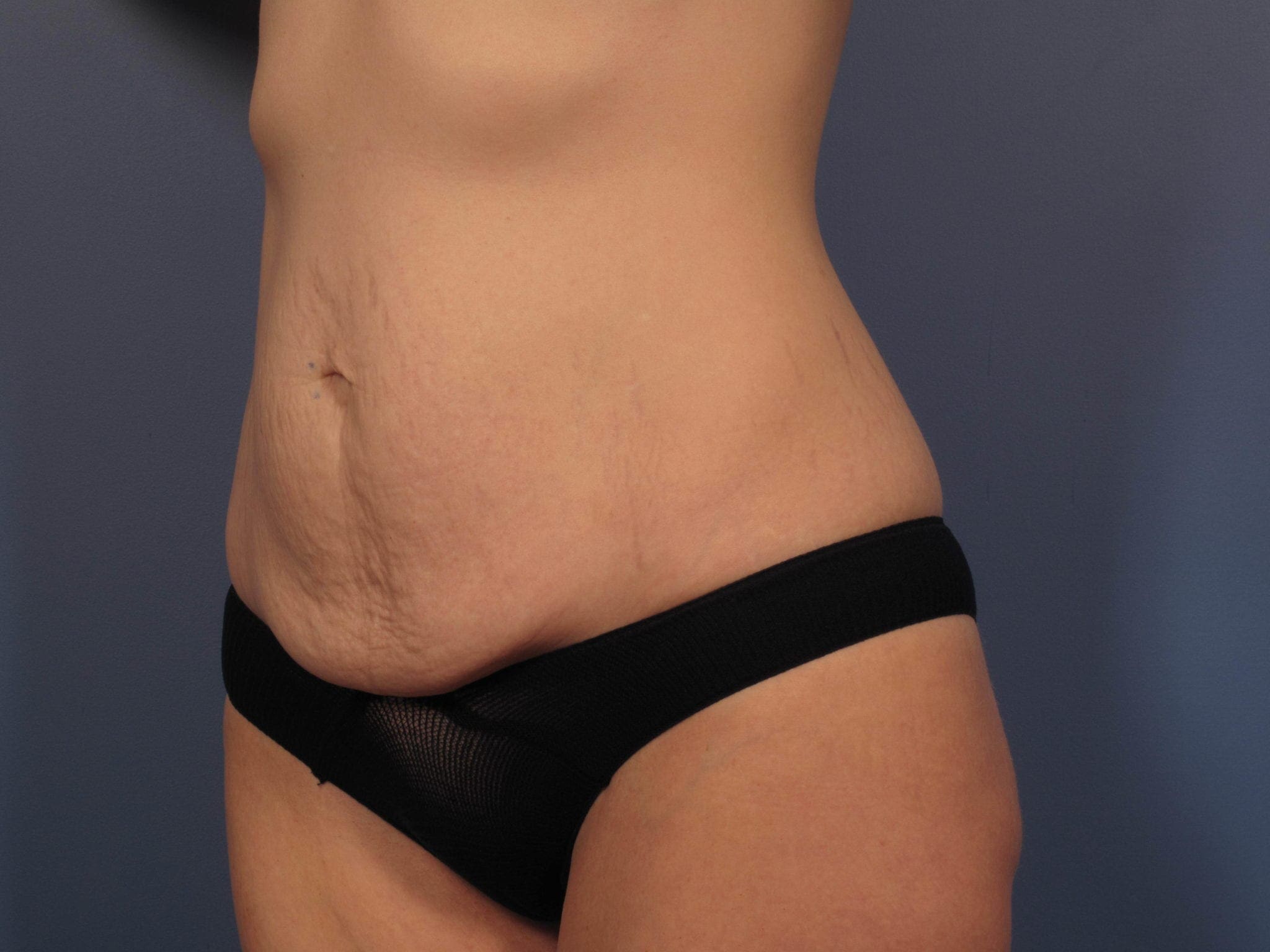 Tummy Tuck Patient Photo - Case 353 - before view-1