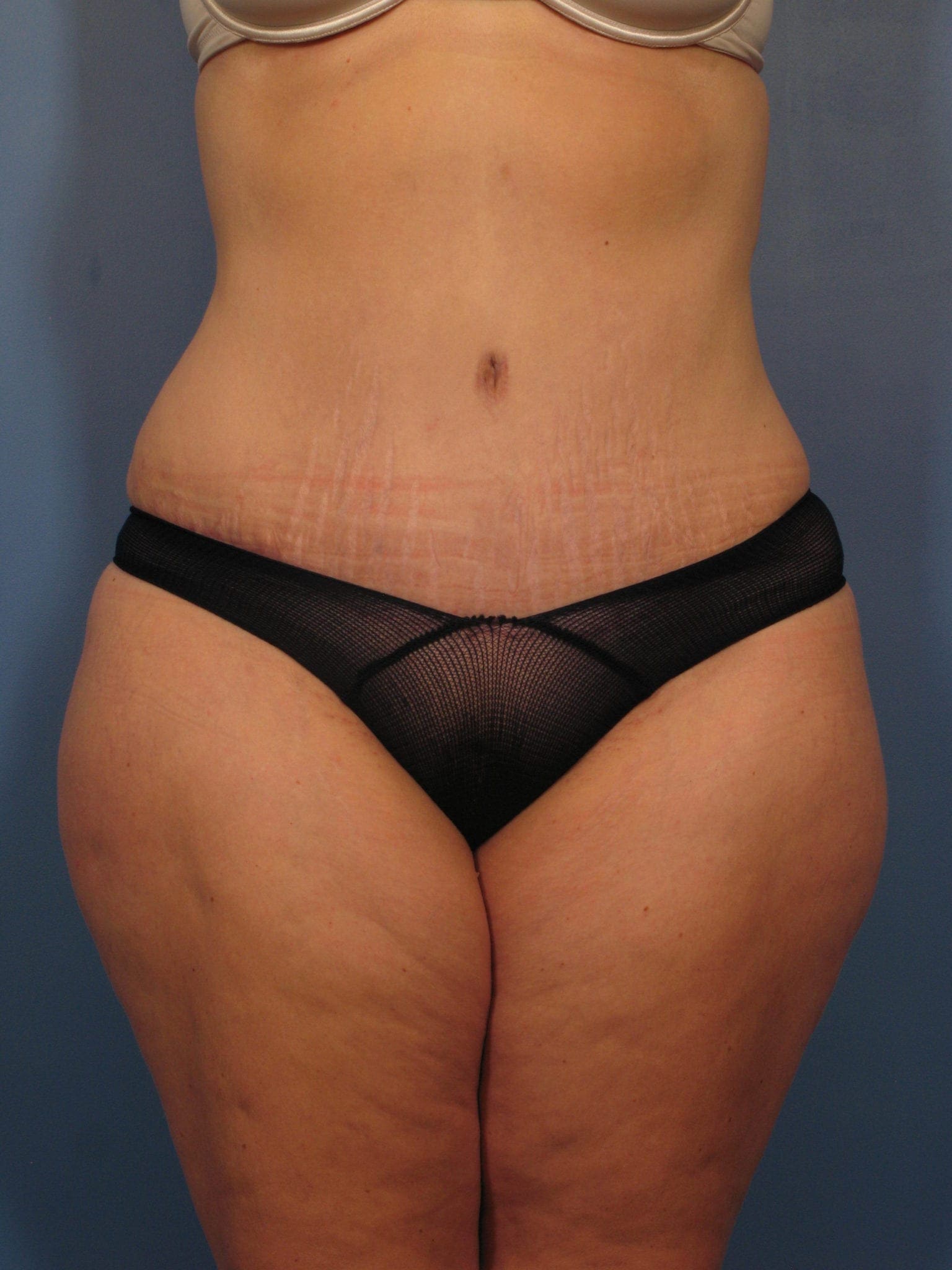 Tummy Tuck Patient Photo - Case 362 - after view-0
