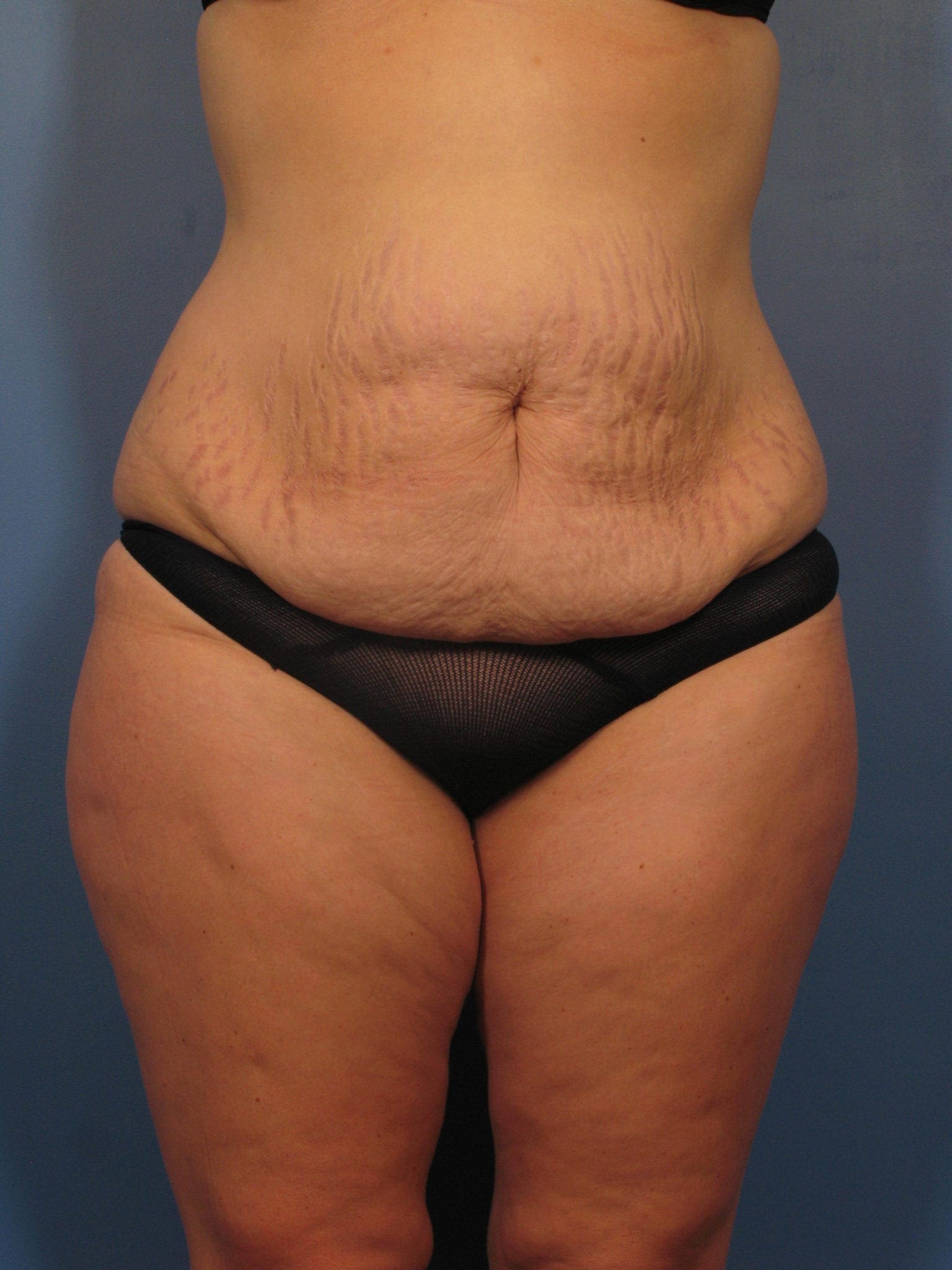 Tummy Tuck Patient Photo - Case 362 - before view-0