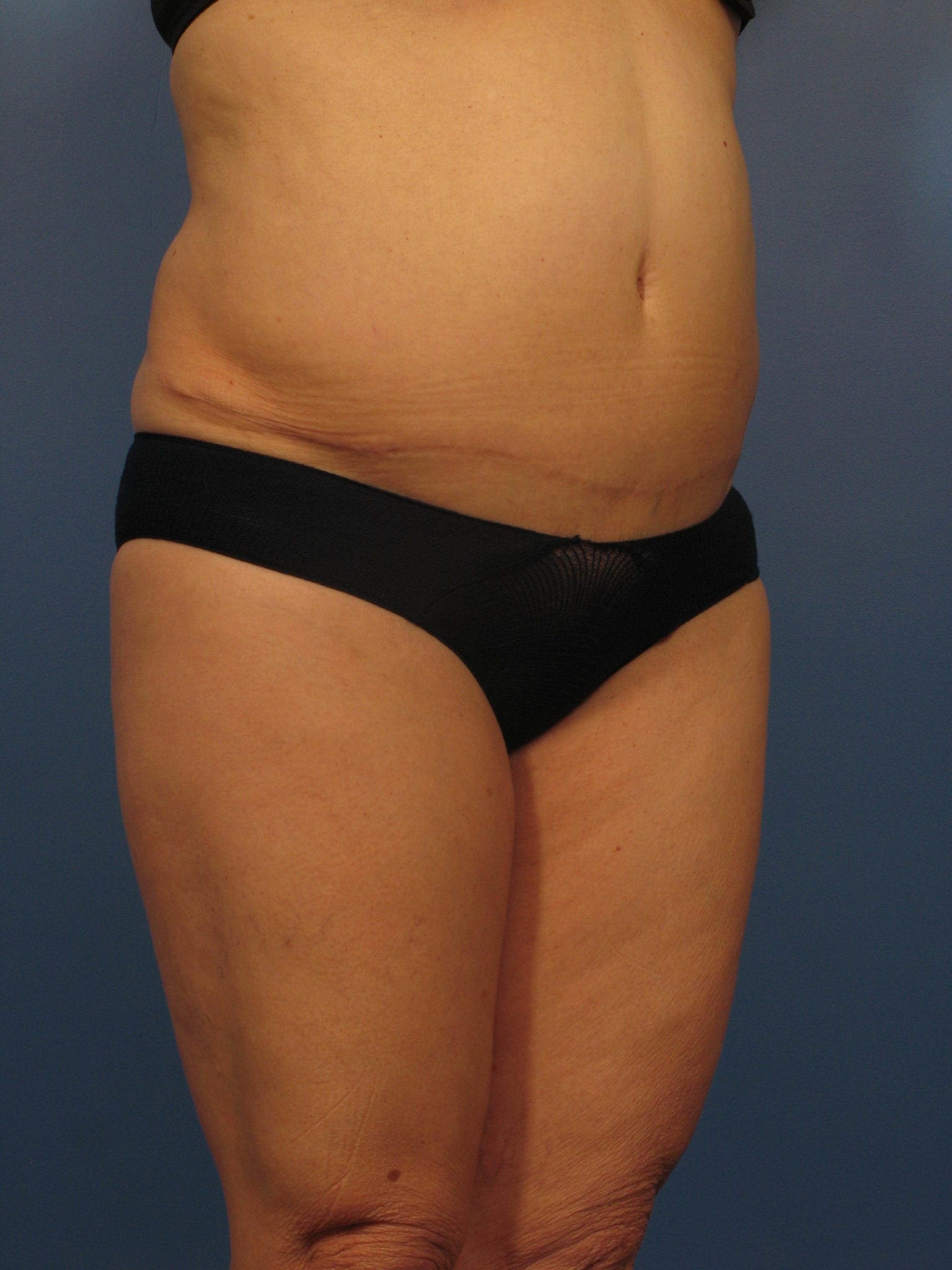 Tummy Tuck Revision Patient Photo - Case 366 - before view-0