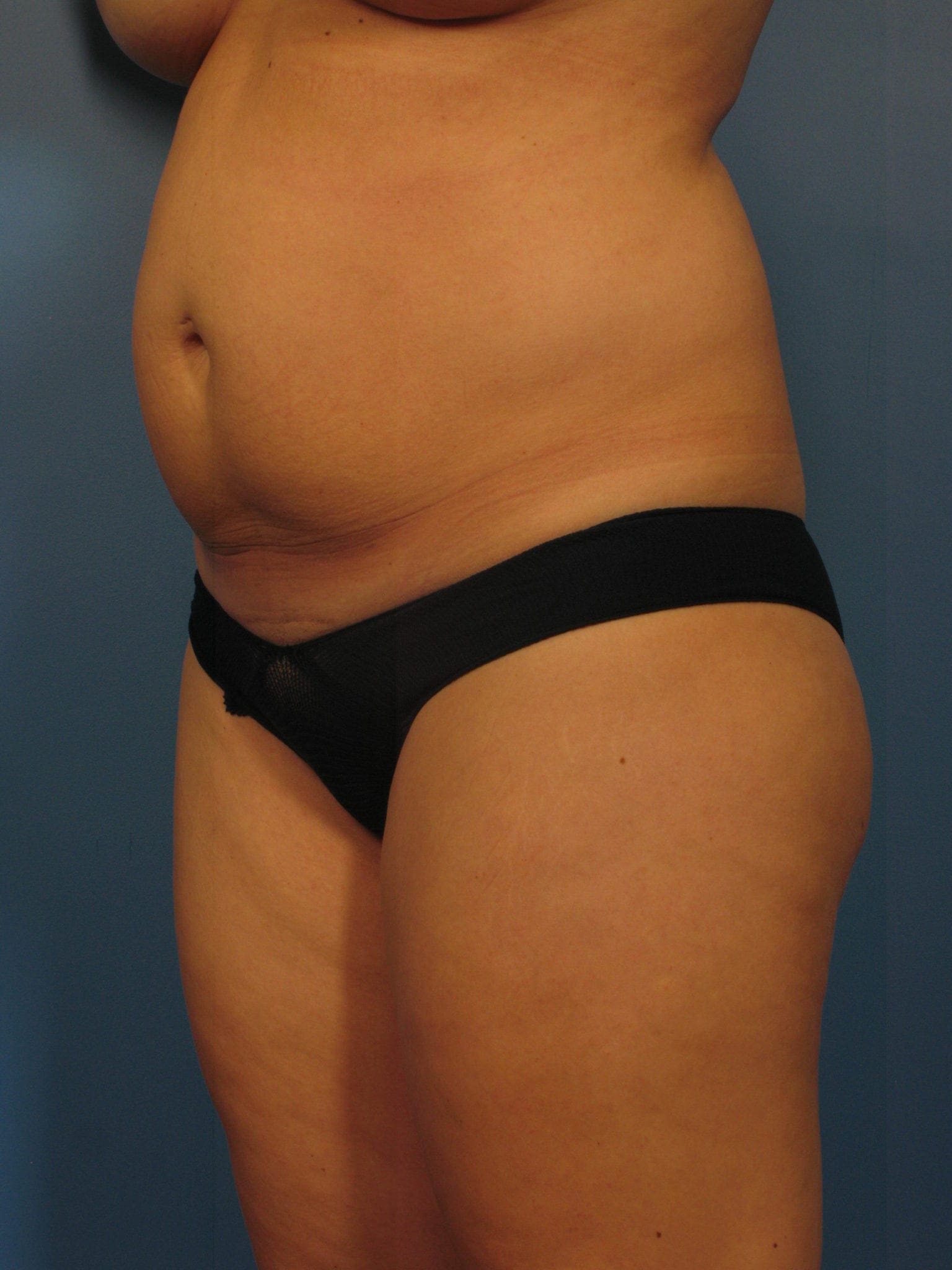 Tummy Tuck Patient Photo - Case 367 - before view-1