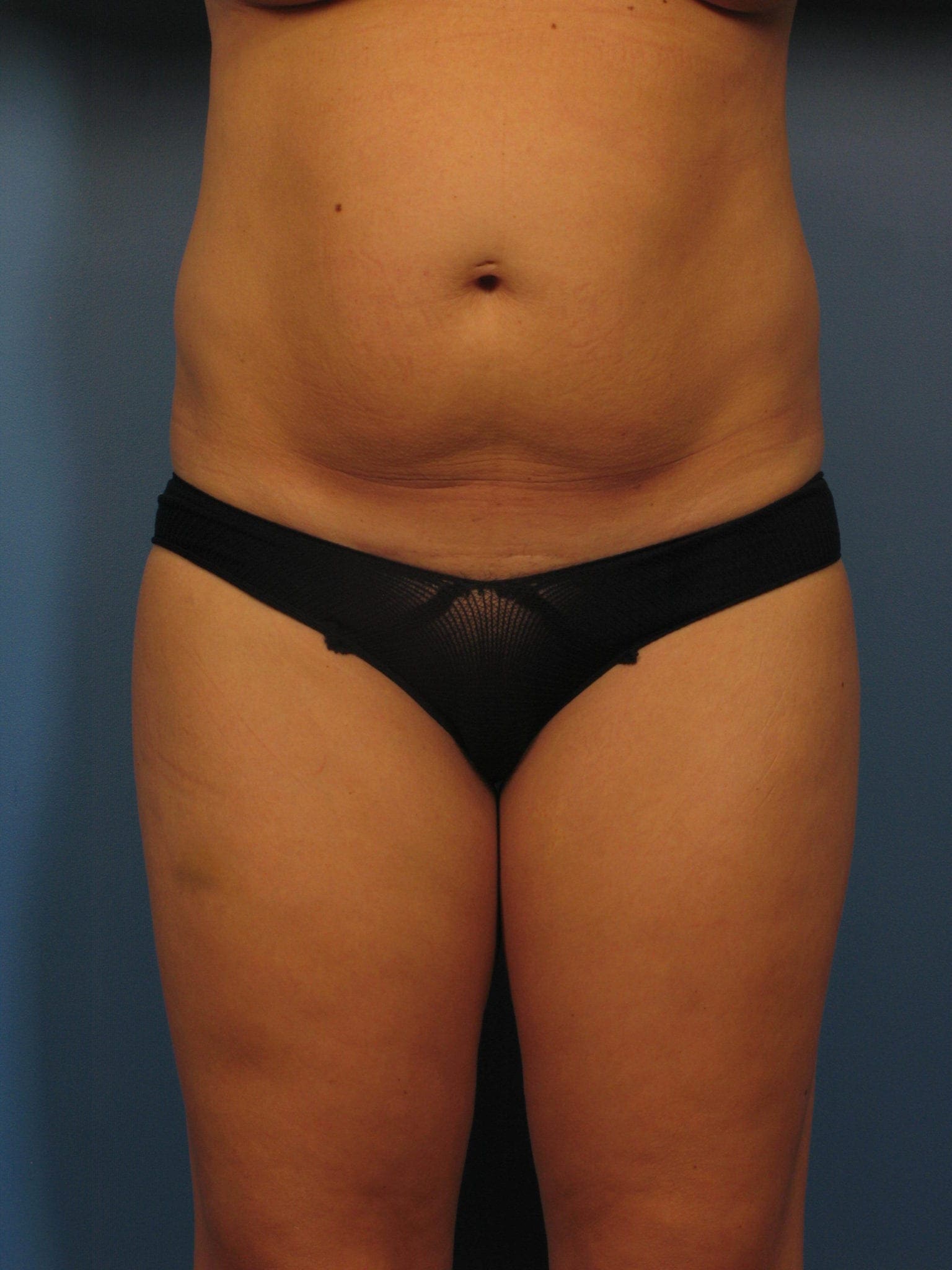Tummy Tuck Patient Photo - Case 367 - before view-0